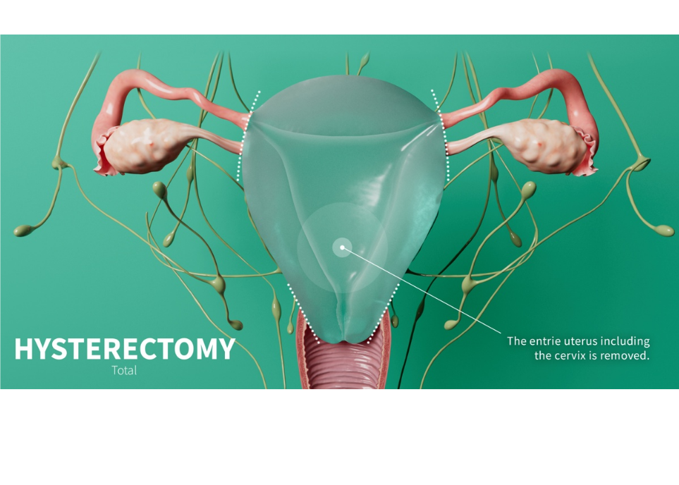 Understanding Hysterectomy — Fibroids, Heavy Bleeding & Prolapse