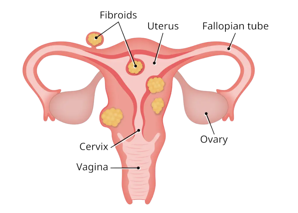 Understanding Uterine Fibroids — Myomectomy & Fibroid Removal