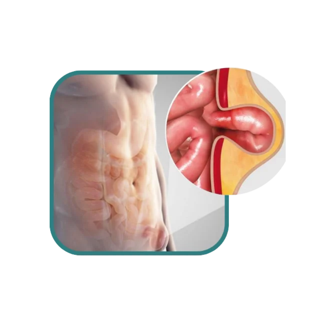 Understanding Hernia — Inguinal, Femoral, Umbilical & Hiatal