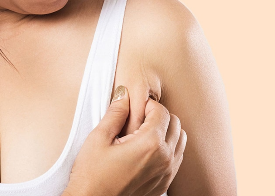 Understanding Axillary (Accessory) Breast Tissue