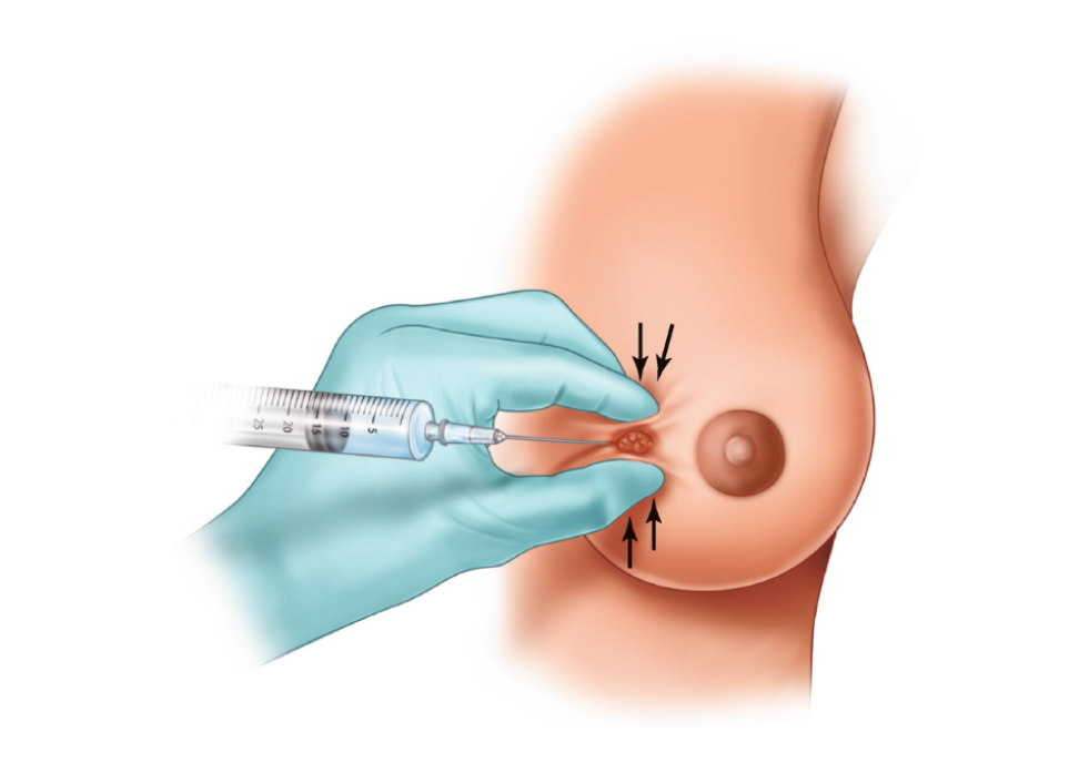 Understanding Breast Cysts — Fluid-Filled Sacs