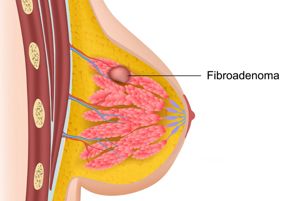 Understanding Breast Lumps — Usually Benign