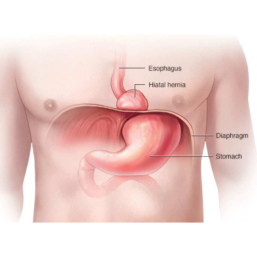 Understanding Hiatal Hernia