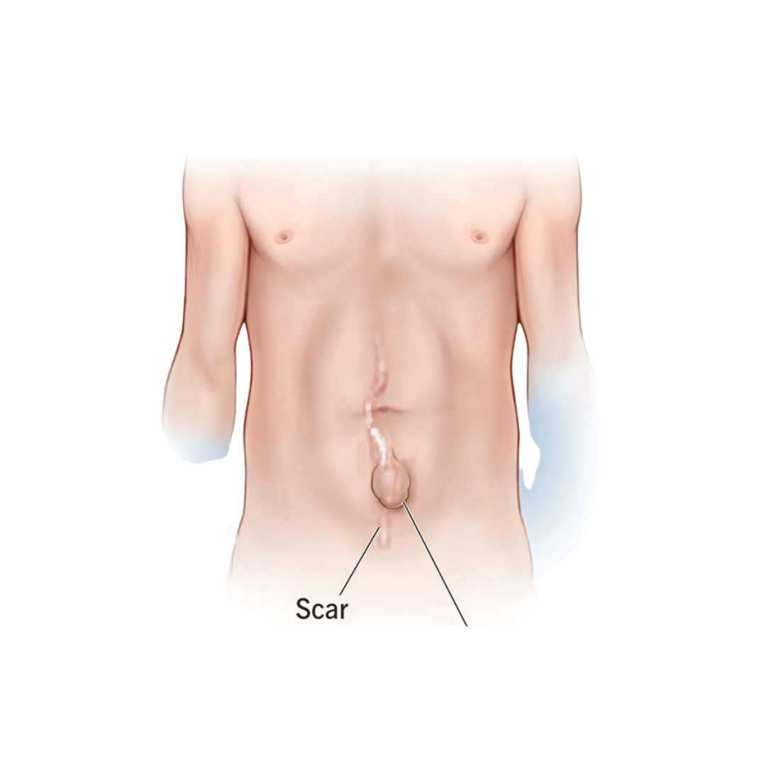 Understanding Incisional Hernia