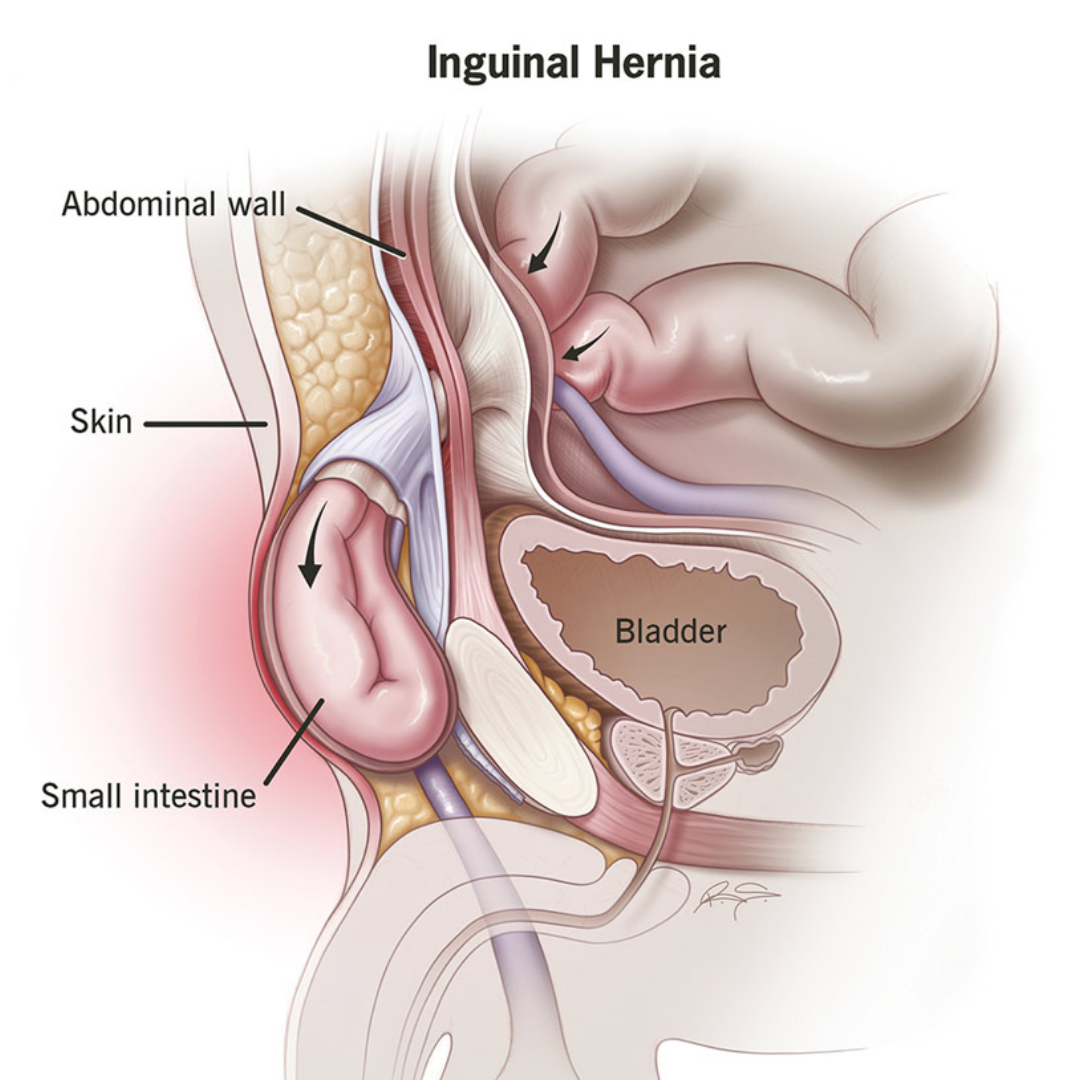Understanding Inguinal Hernia