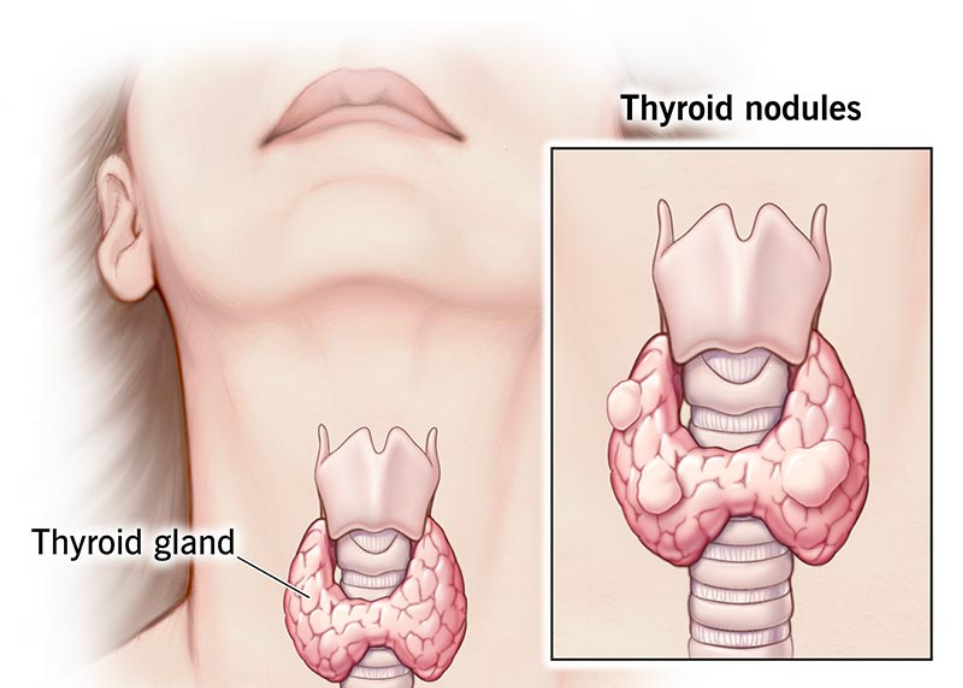 Understanding a Solitary Benign Thyroid Nodule