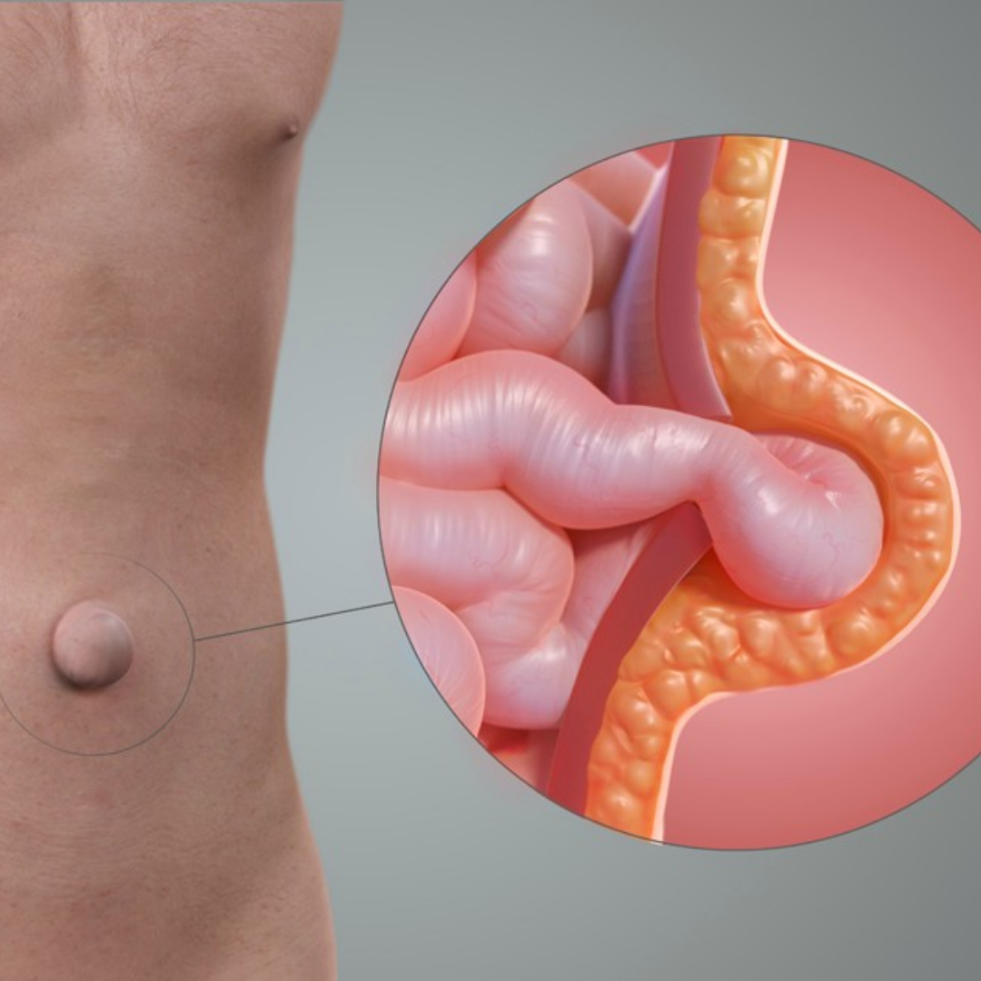 Understanding Umbilical Hernia