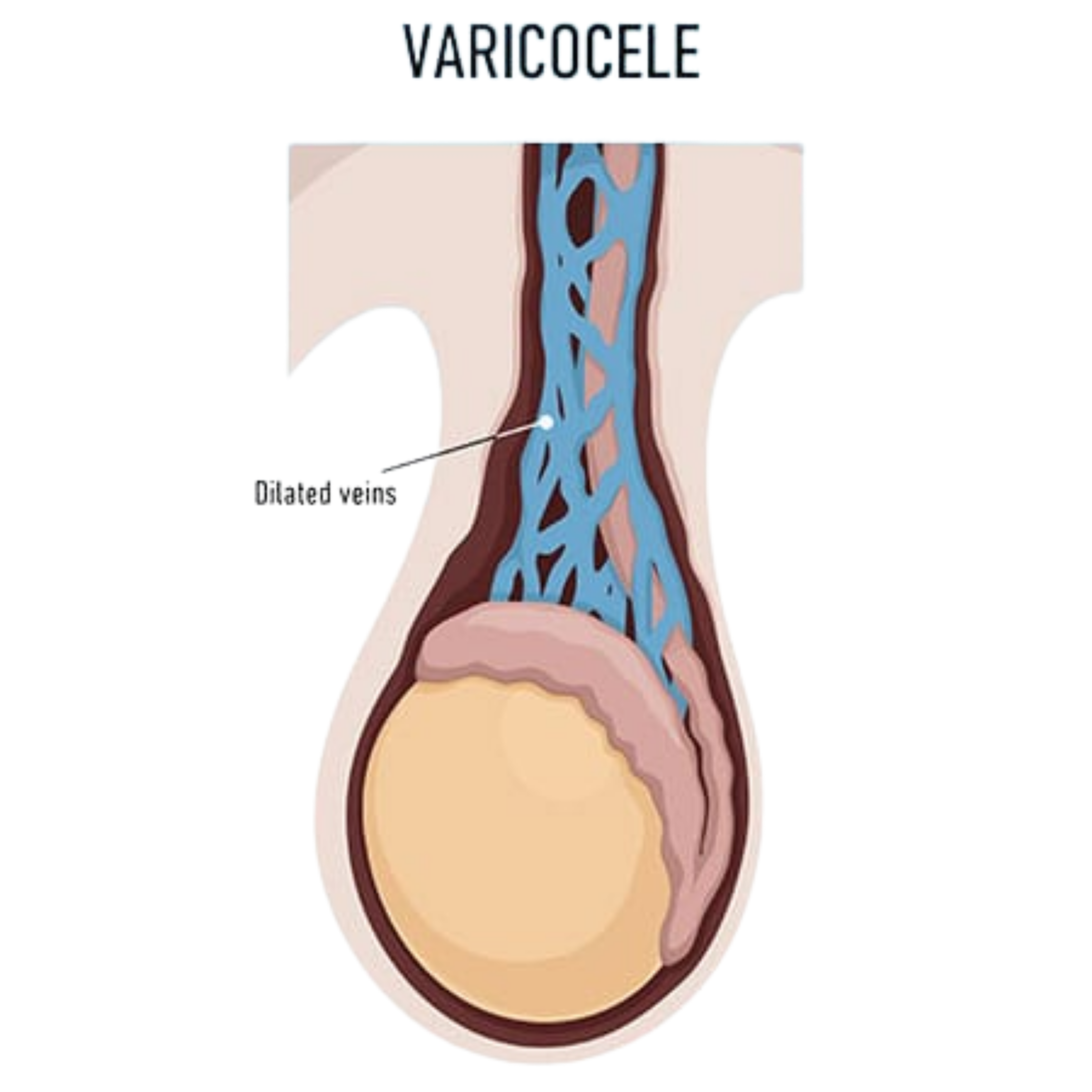 Understanding Varicocele — Enlarged Veins in the Scrotum