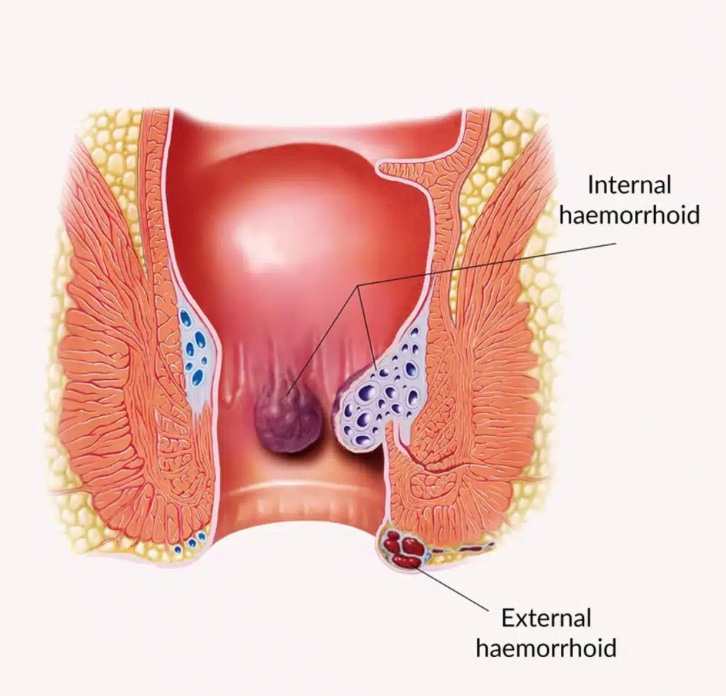 Understanding Piles (Hemorrhoids) — Internal and External