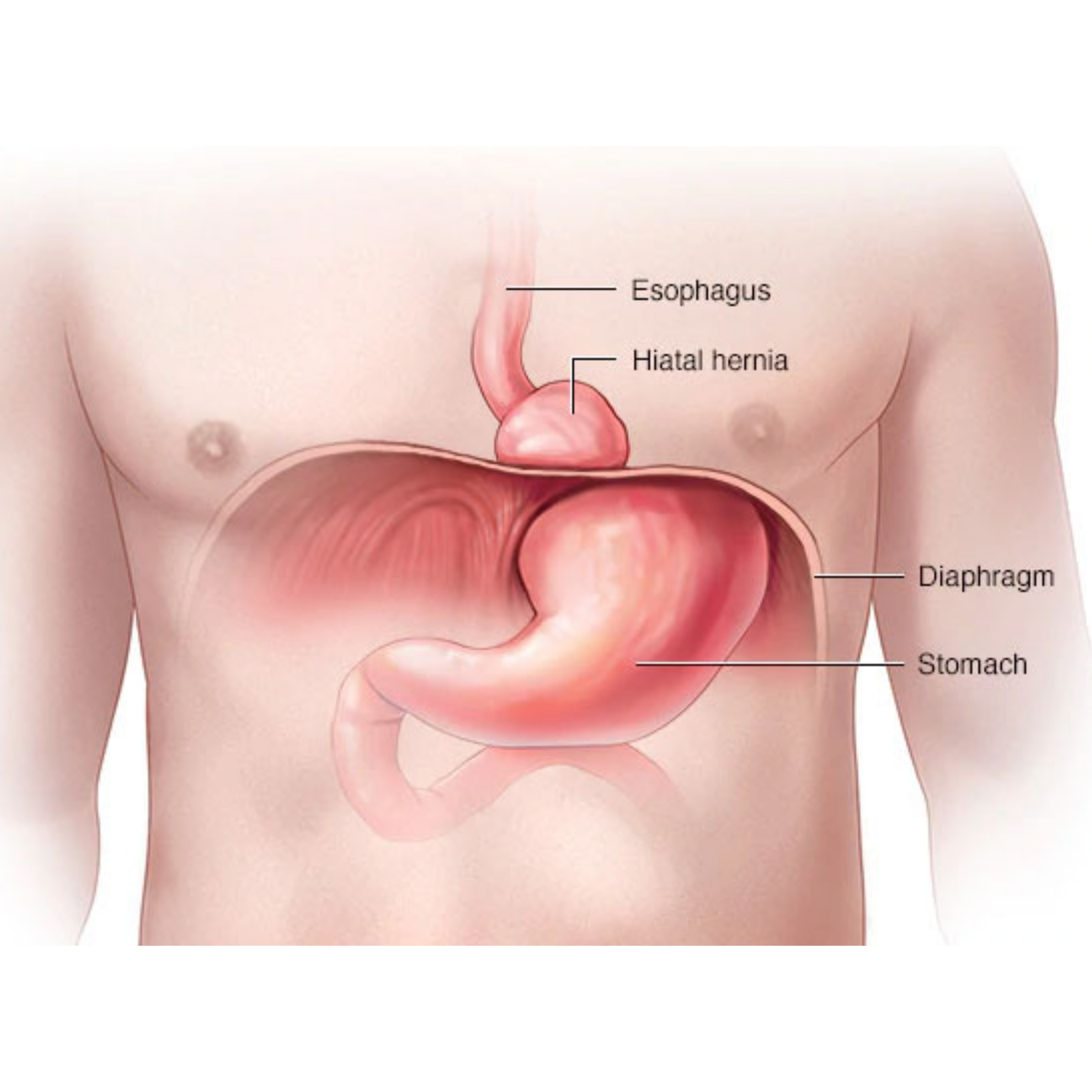 Understanding Hernia — Inguinal, Femoral, Umbilical & Hiatal
