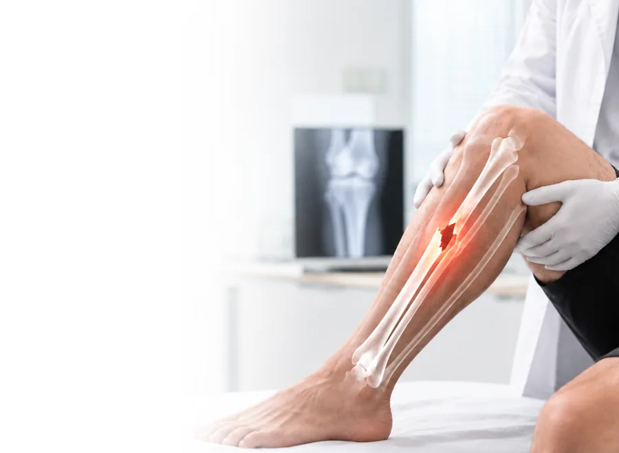 Doctor examining a lower leg with a broken shin bone shown, an X-ray behind