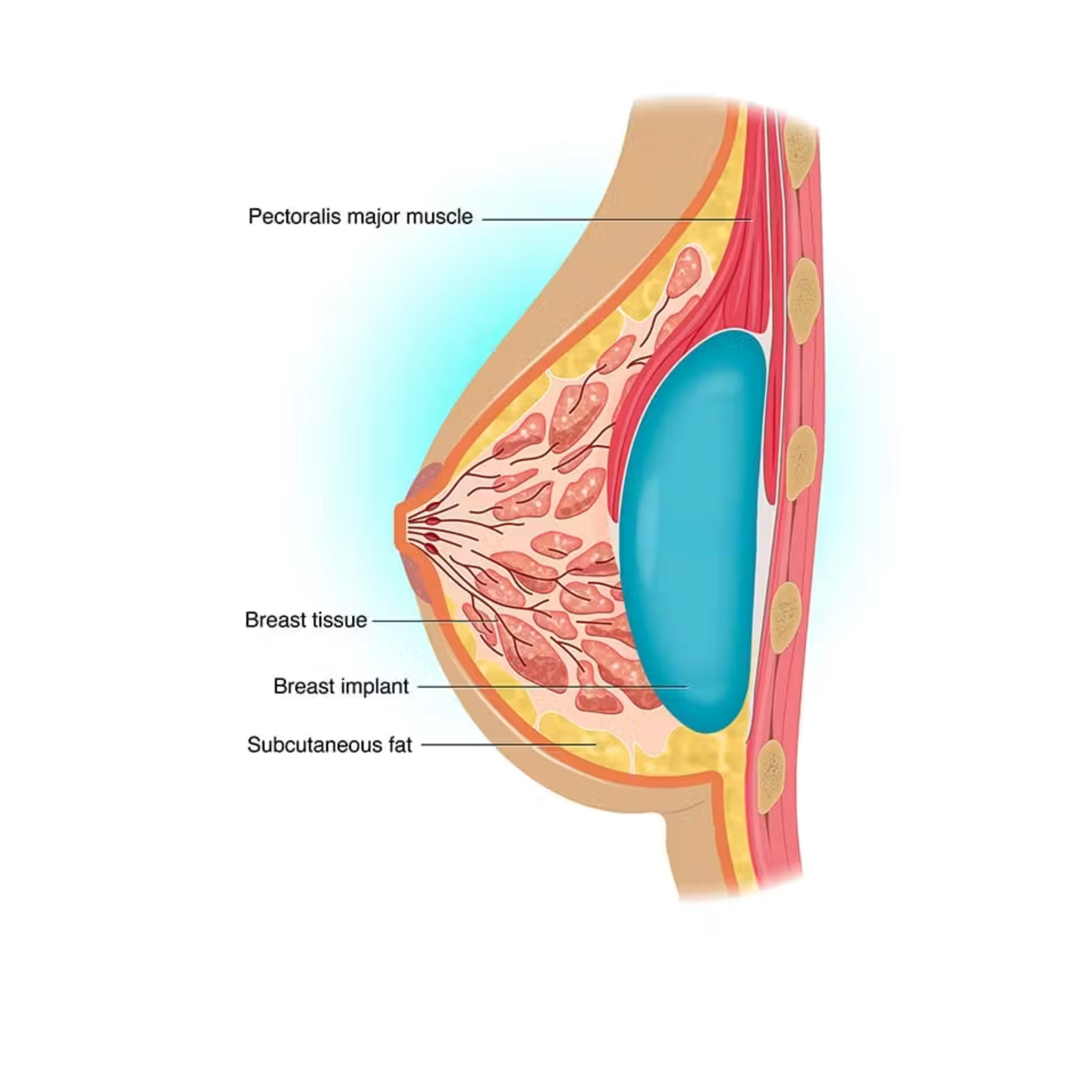 Understanding Breast Augmentation — Implants & Fat Transfer