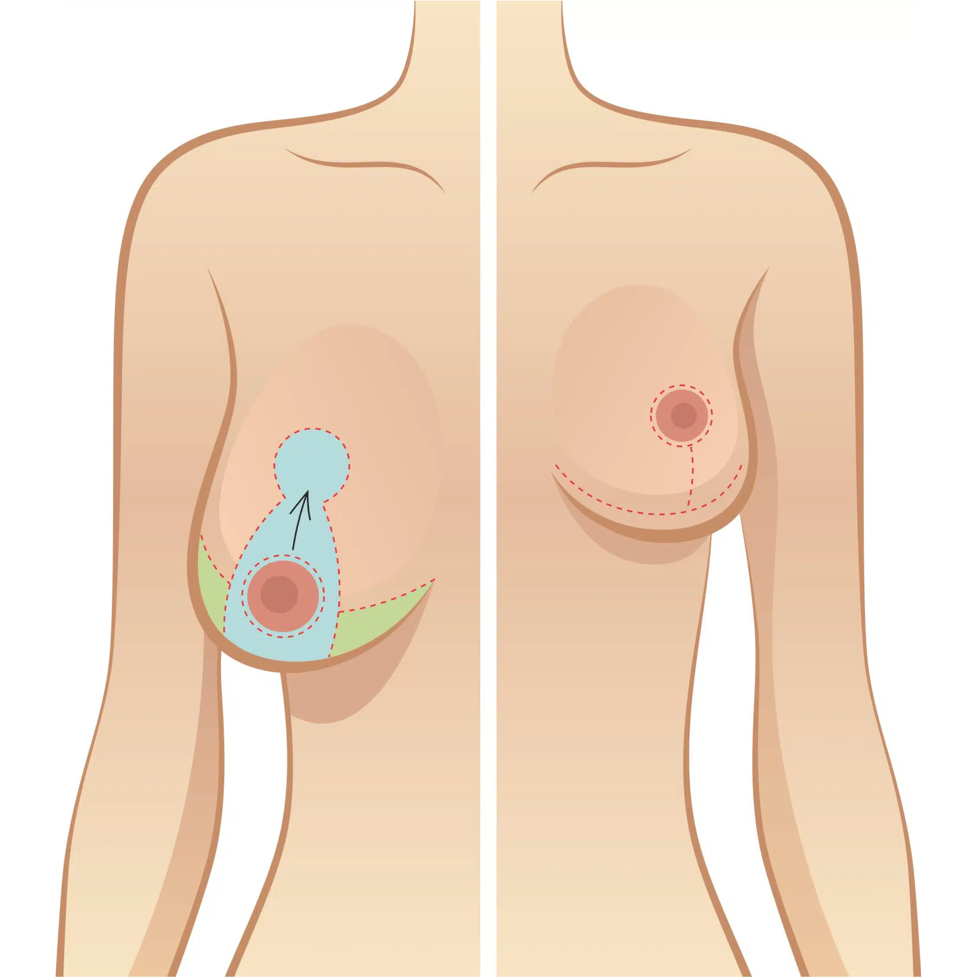 Understanding Breast Reduction — Reduction Mammoplasty