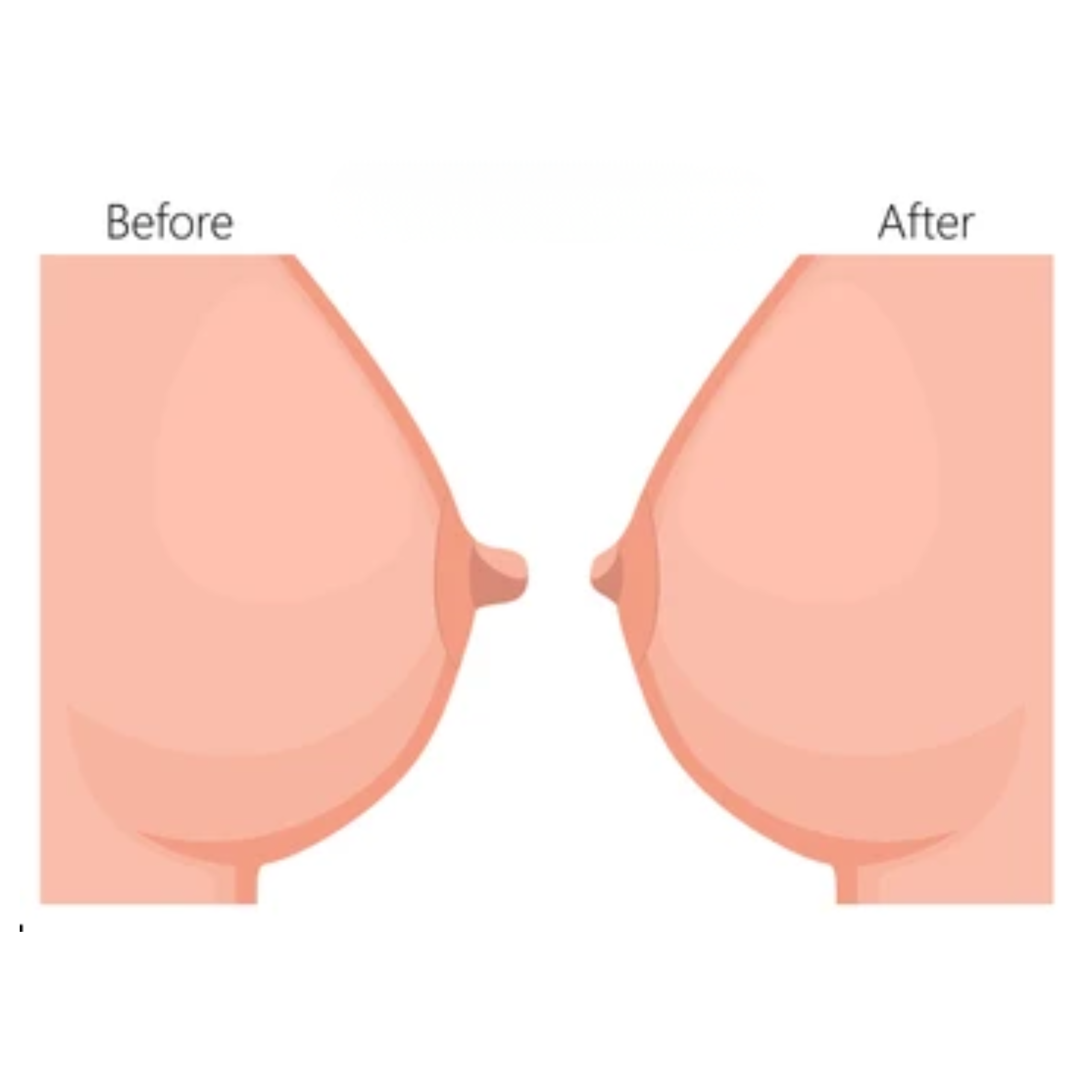 Understanding Nipple & Areola Correction