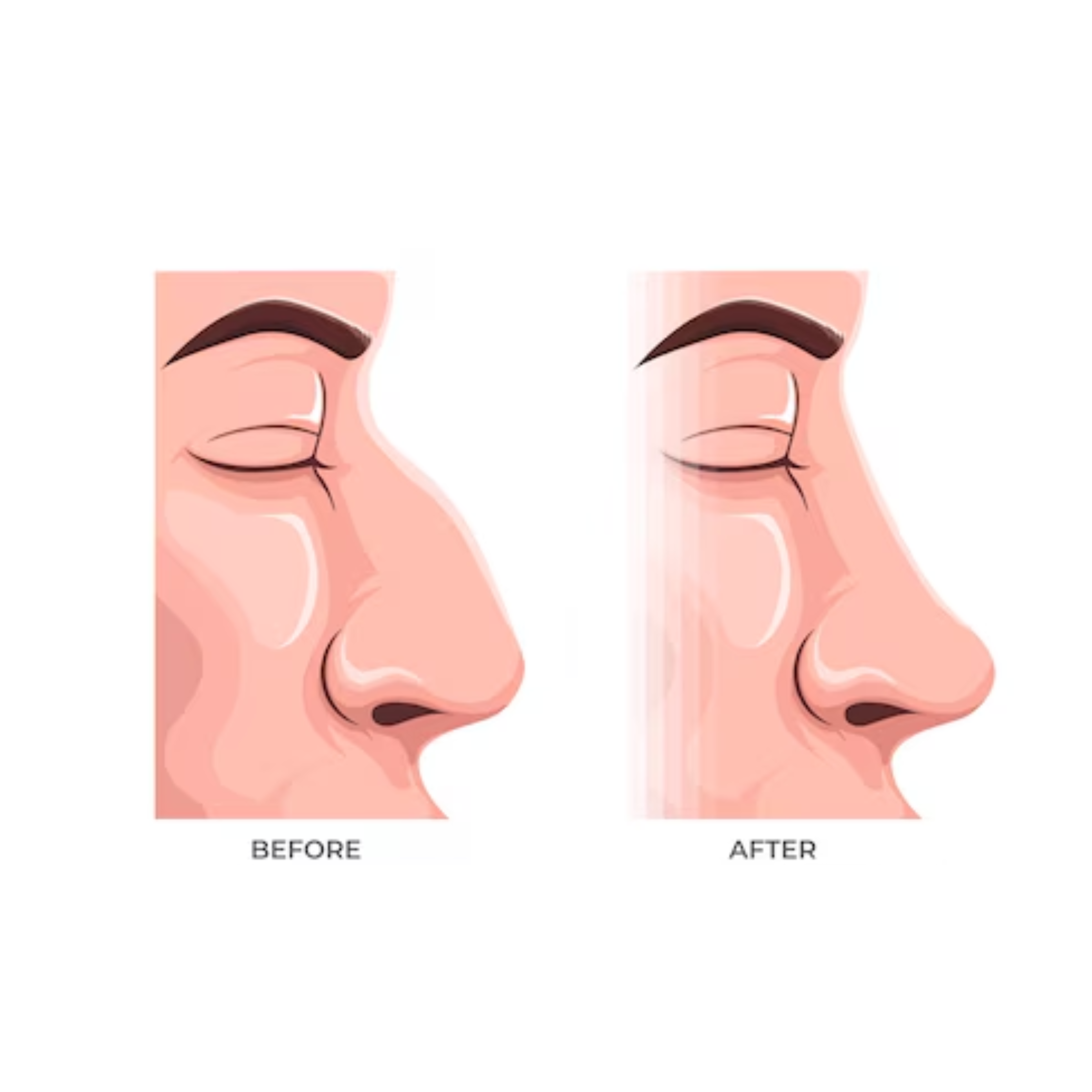 Understanding Rhinoplasty — Nose Reshaping