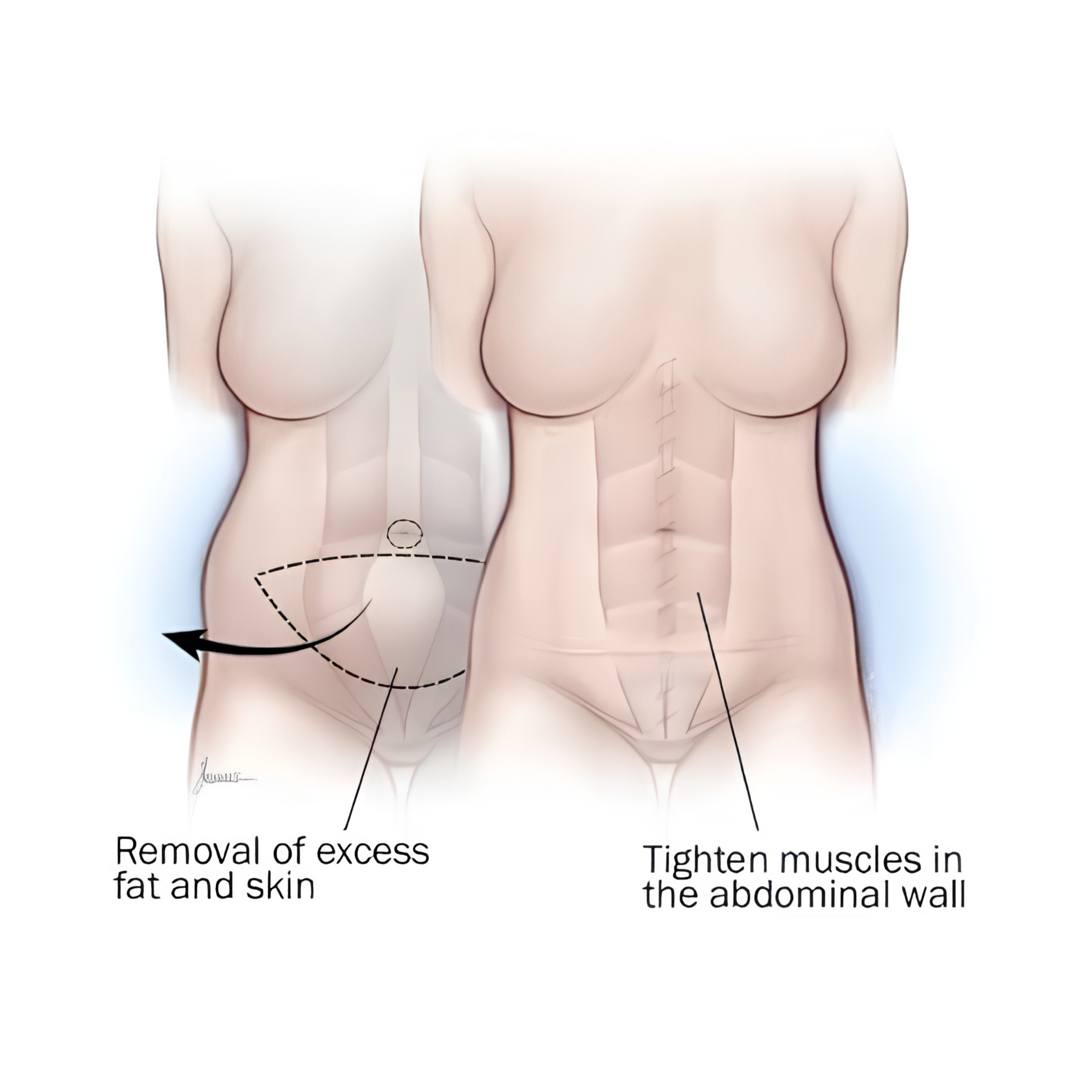 Tummy Tuck Results — Female